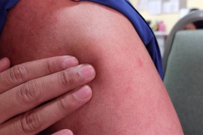 Yağ bezesi neden çıkar? Tedavileri nelerdir?